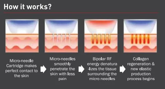 Micro Needle Fractional RF Golden Microneedling Machine for Acne Scars Removal, Microneedle Fractional RF Skin Tightening Device