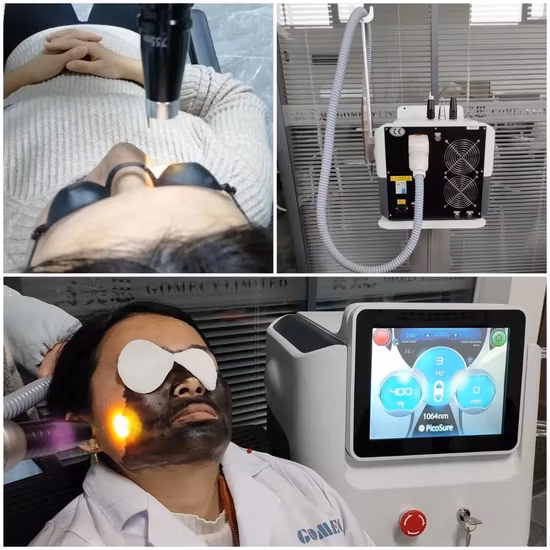 Prezzo di fabbrica!  Rimozione di tatuaggi, rimozione di pigmenti, trattamento dell'acne, dispositivo per sbiancamento della pelle